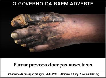 Macau 2013 Health Effect vascular system - gangrene, diseased foot, gross (Portuguese)